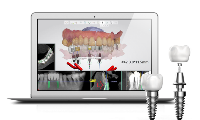 네비게이션임플란트